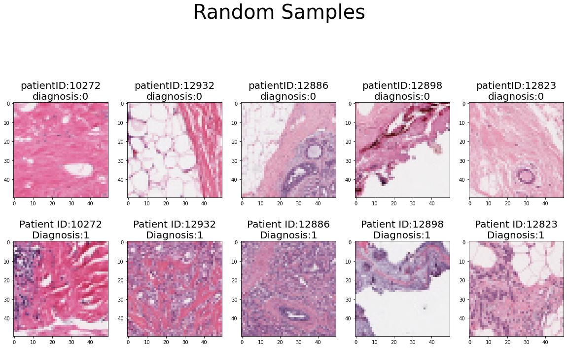 IDC Histology images