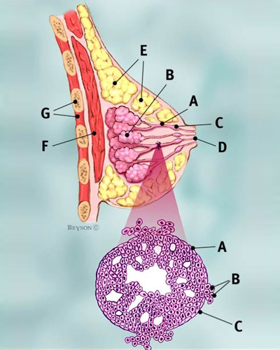 Invasive Ductual Carcinoma